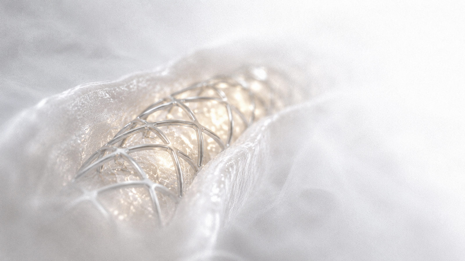 A coronary stent expanded inside a vessel.